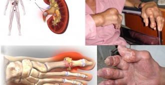  Phân loại gout và biến chứng nghiêm trọng của bệnh gout